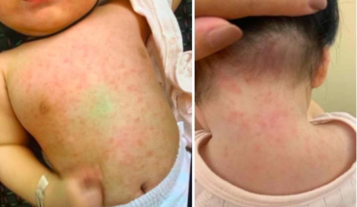 怎么判断宝宝是不是得了幼儿急疹