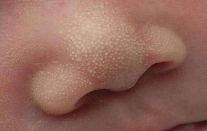 02新生儿粟粒疹有些新生儿臀部,背部或四肢上可见到蓝绿色的色斑,大小