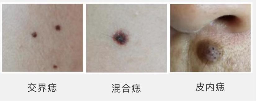 混合痣:略隆起皮肤,多见于儿童和少年;交界痣:出生时即有,或出生后不
