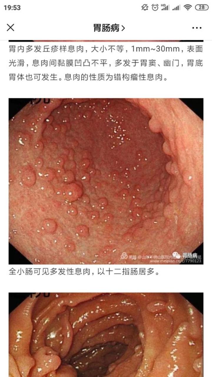 遗传相关胃肠道息肉病之——cowden综合征 - 微医(挂号网)