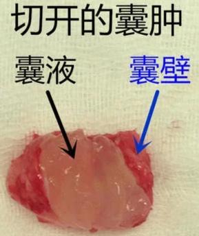 什么是腱鞘囊肿都需要手术治疗吗