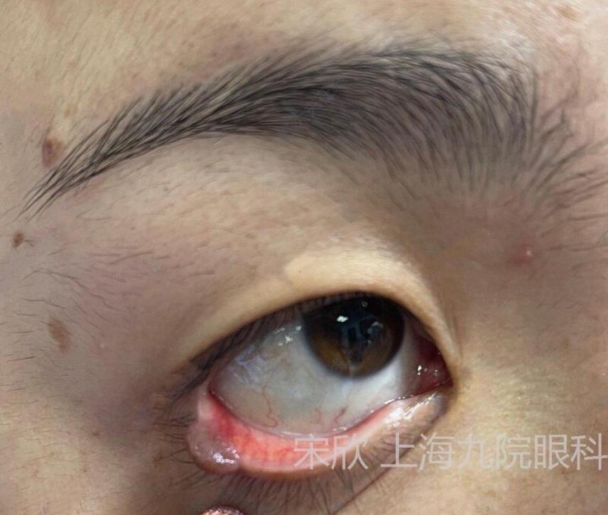 眼睑肿瘤