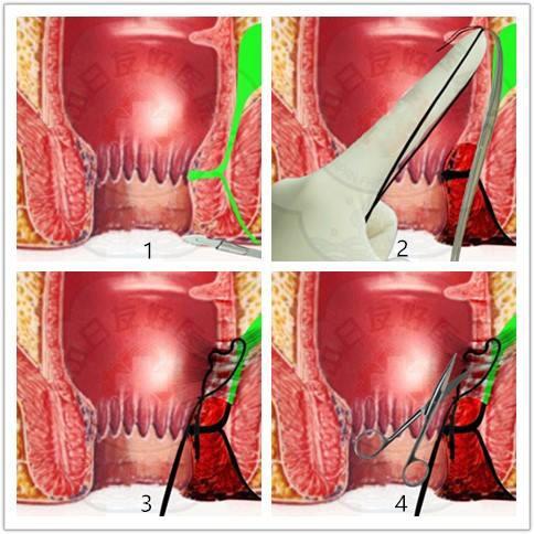 长大后我就成了你肛瘘与肛周脓肿的深情对唱