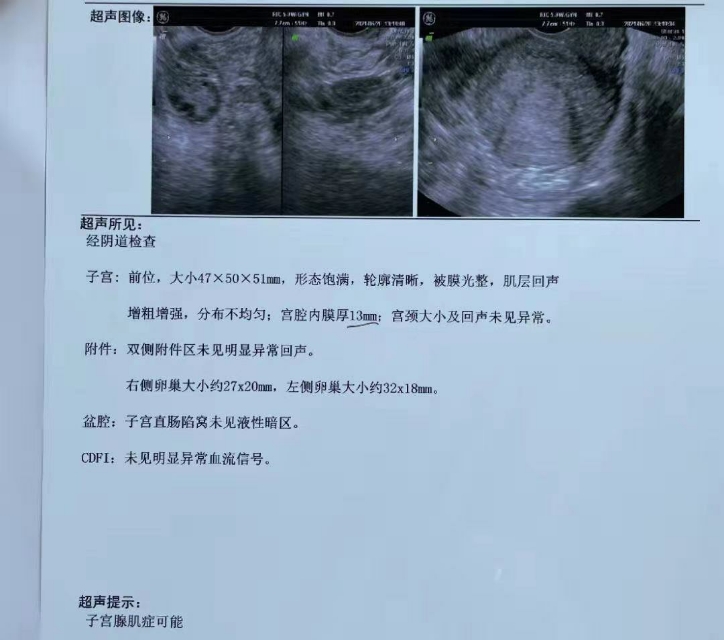 子宫腺肌症终于说再见了