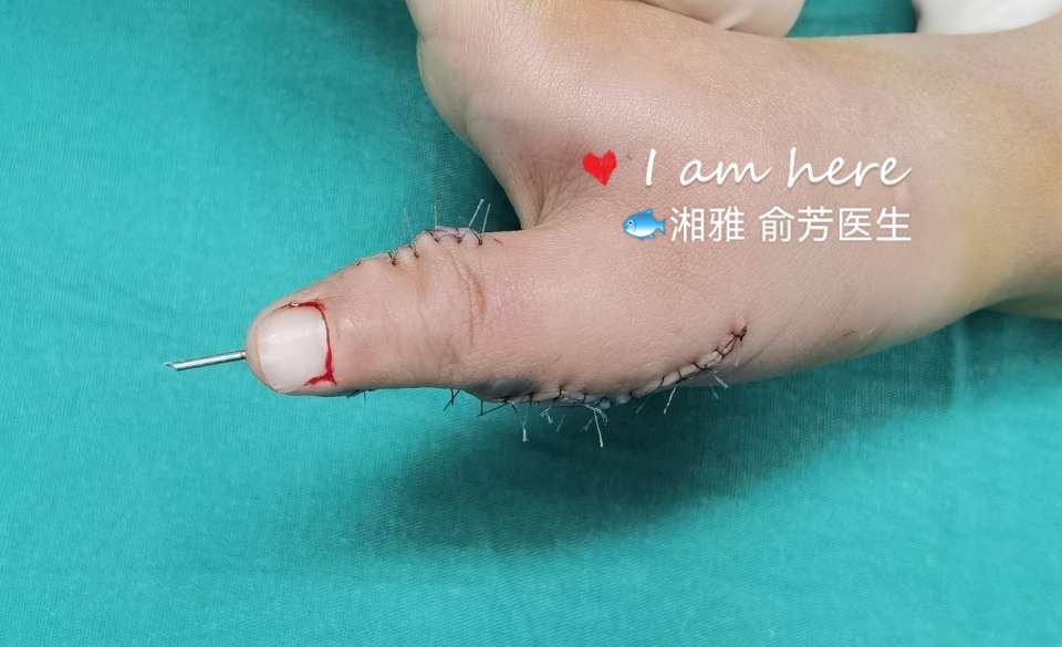 复拇指畸形翻修一例