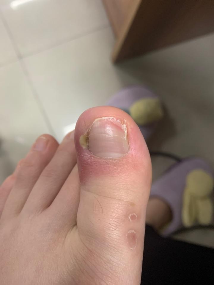 甲沟炎取出脚指甲发炎