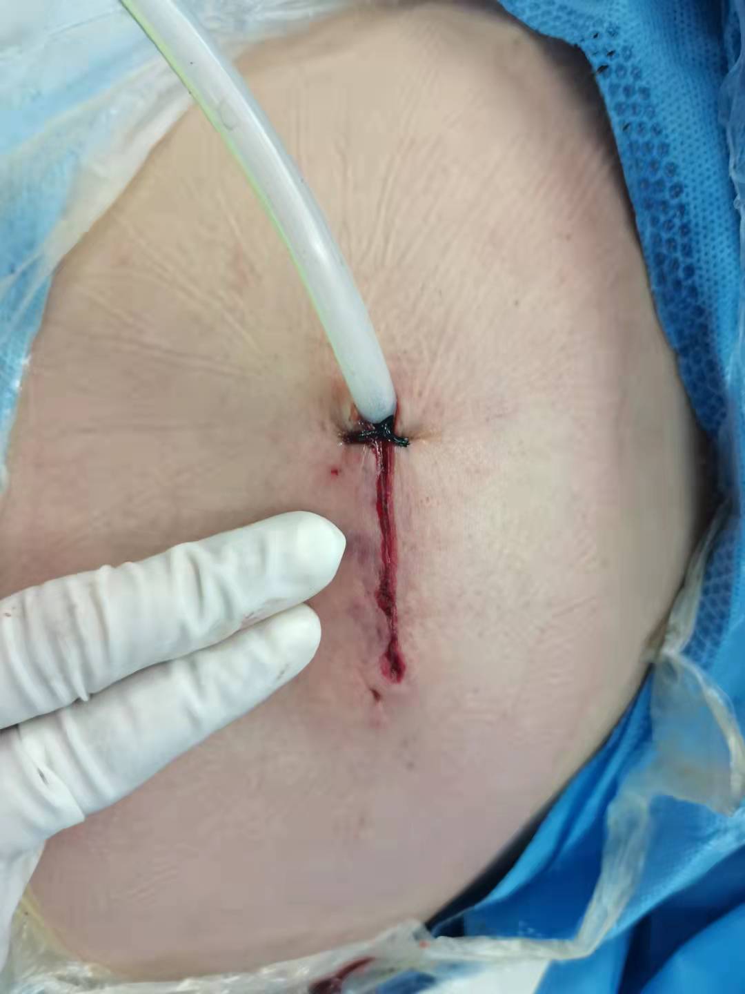 今日经单孔胸腔镜(uvats)行右后纵隔肿瘤切除,手术过程顺利,手术切口