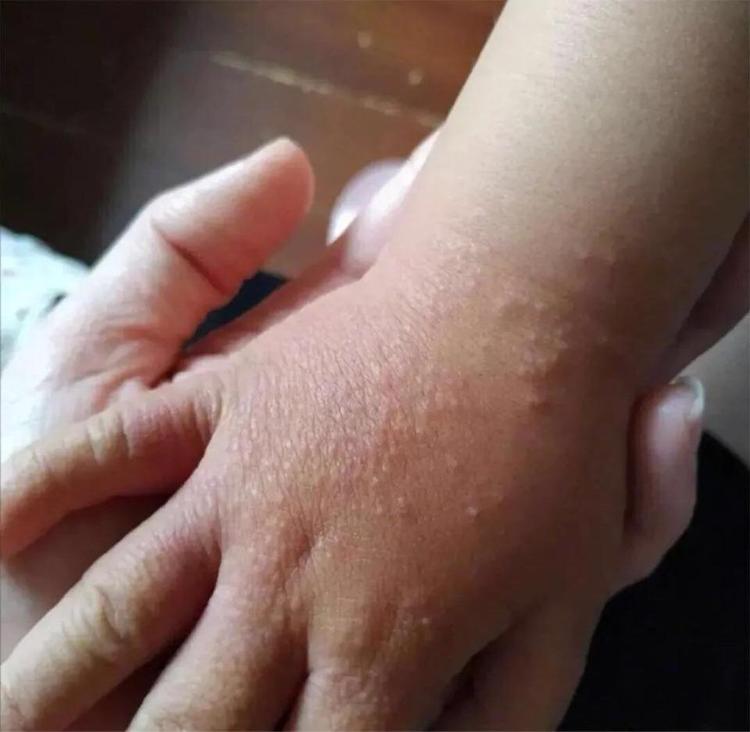 样",由于夏天到来,孩子们户外活动的增加,使得这个病在春夏尤其多见!