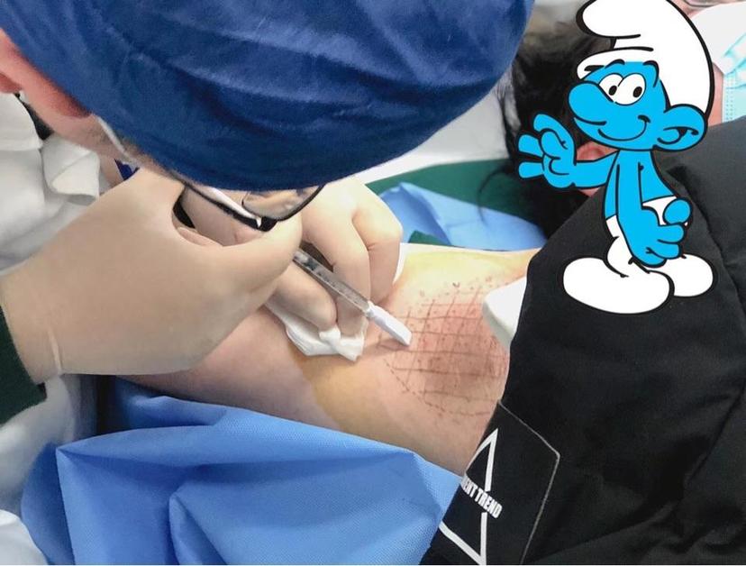 第四代注射治疗腋臭腋臭狐臭