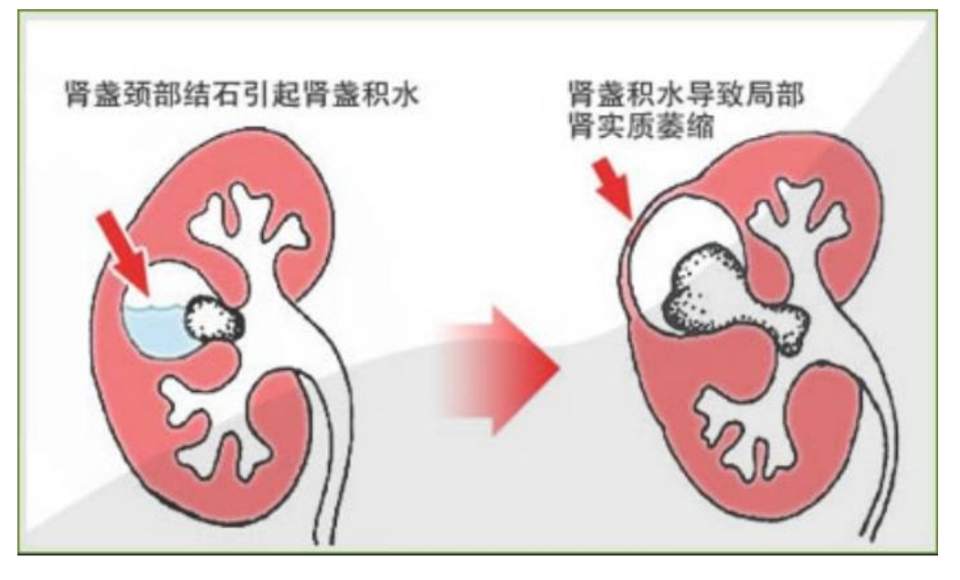 尿管结石怎么快速排出图片