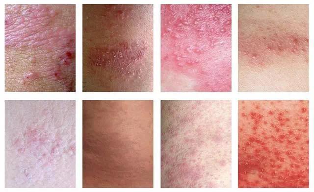 对的时间点6肖丹一根扁弧刃针治愈顽固湿疹