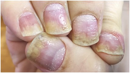 如何识别早期银屑病关节炎