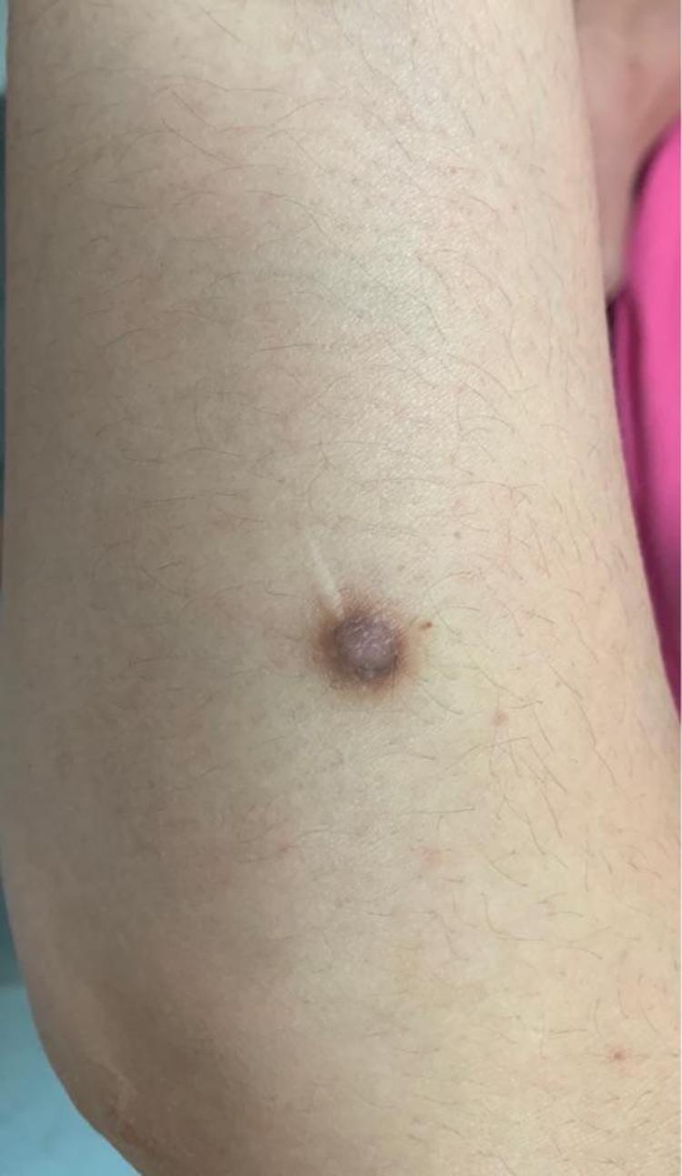 角化棘皮瘤与皮肤纤维瘤 - 微医(挂号网)