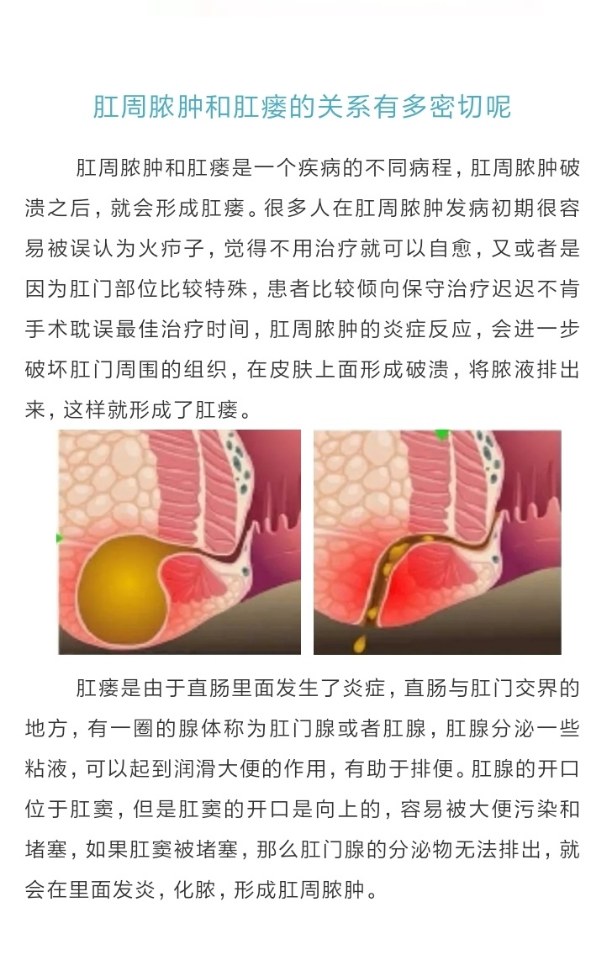 疖子和肛周脓肿区别图图片