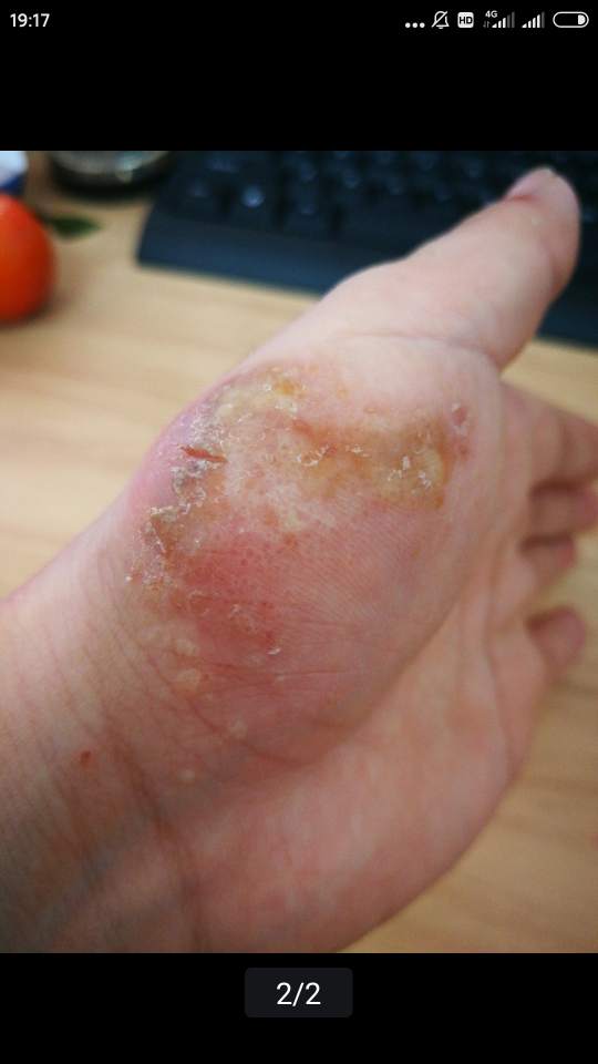 皮肤真菌感染 初期图片