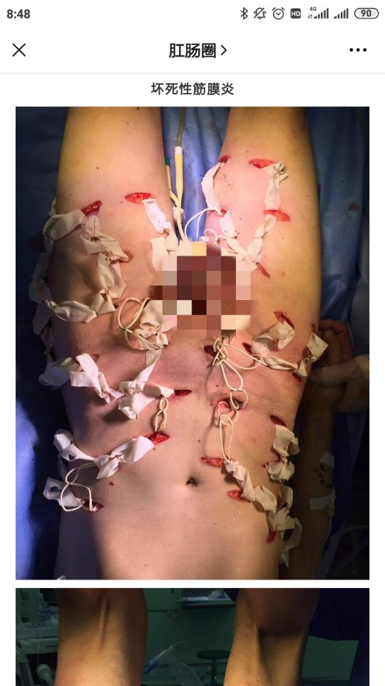突发坏死性筋膜炎知名音乐人乘机身亡