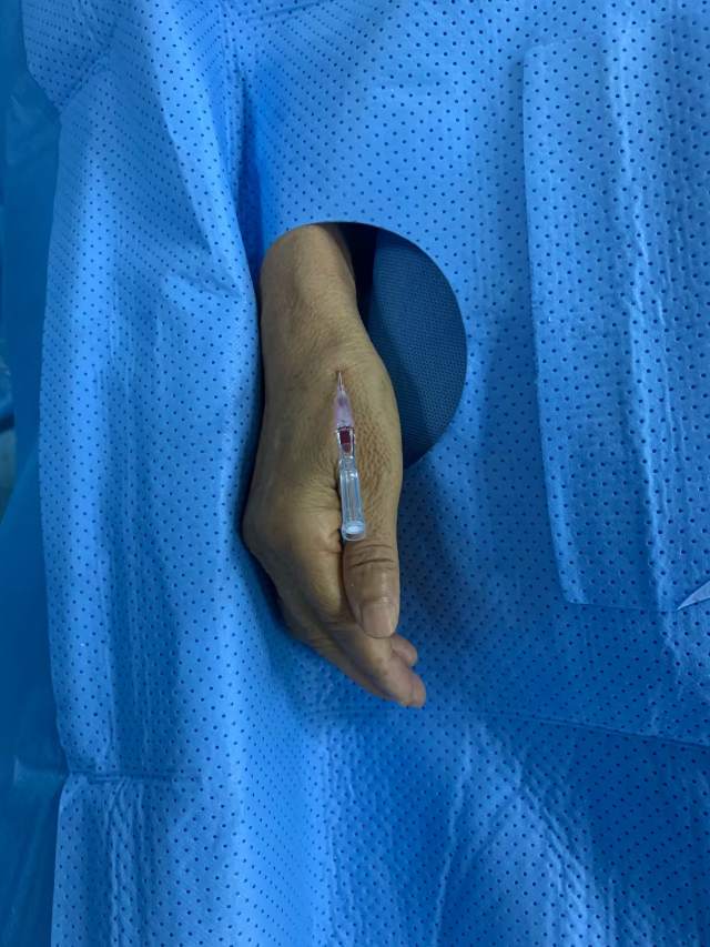 远侧桡动脉入路脉络膜前动脉壶腹部动脉瘤8m复查