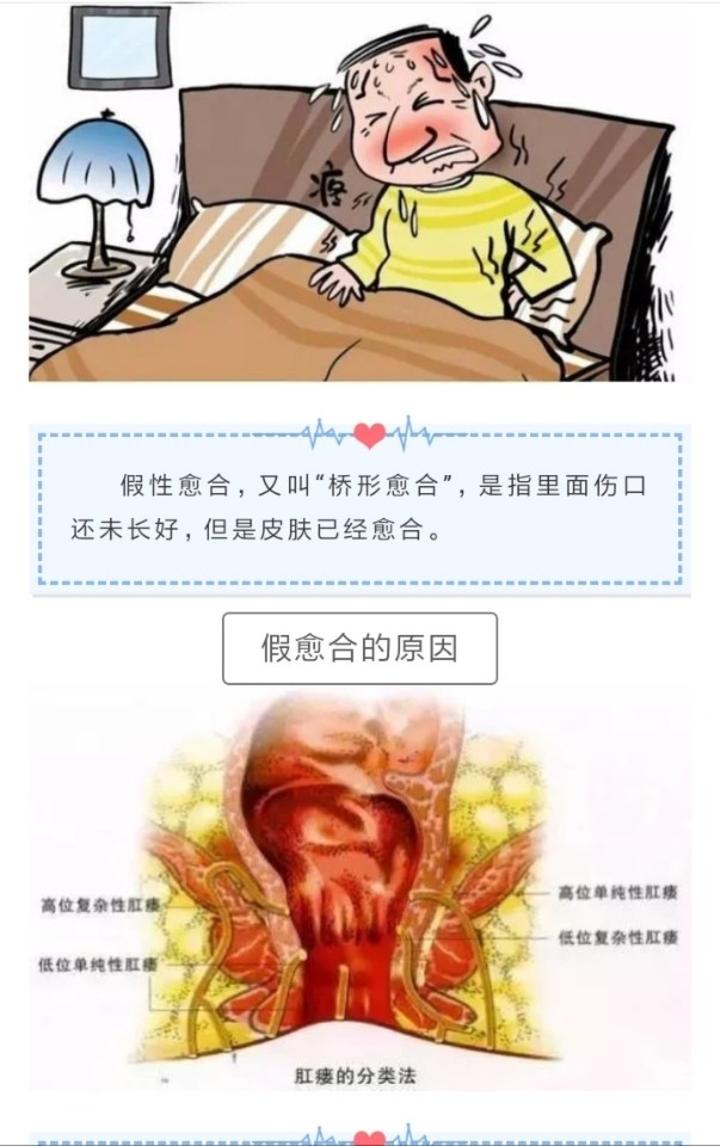 什么叫假愈合带你认识肛肠疾病术后假性愈合的原因及处理