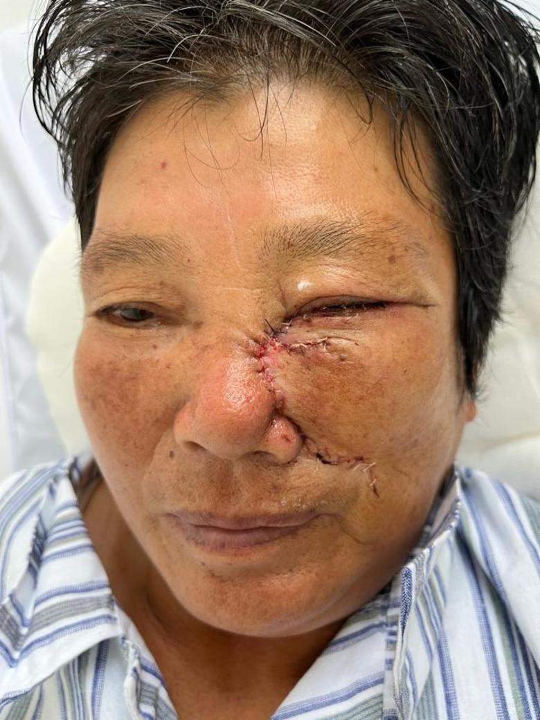 鼻背基底细胞癌扩切皮瓣修复