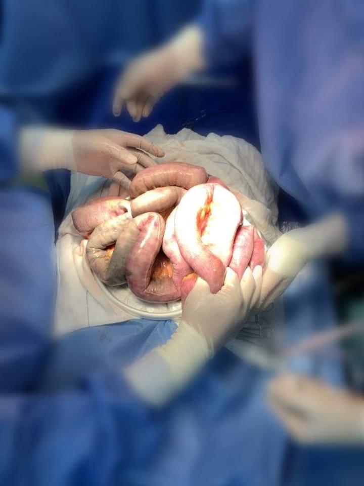 肝血管积气,肠梗阻,肠缺血,气腹,感染性休克,危及生命急诊手术