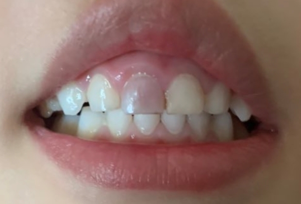 外伤后牙齿变黑原因及处理