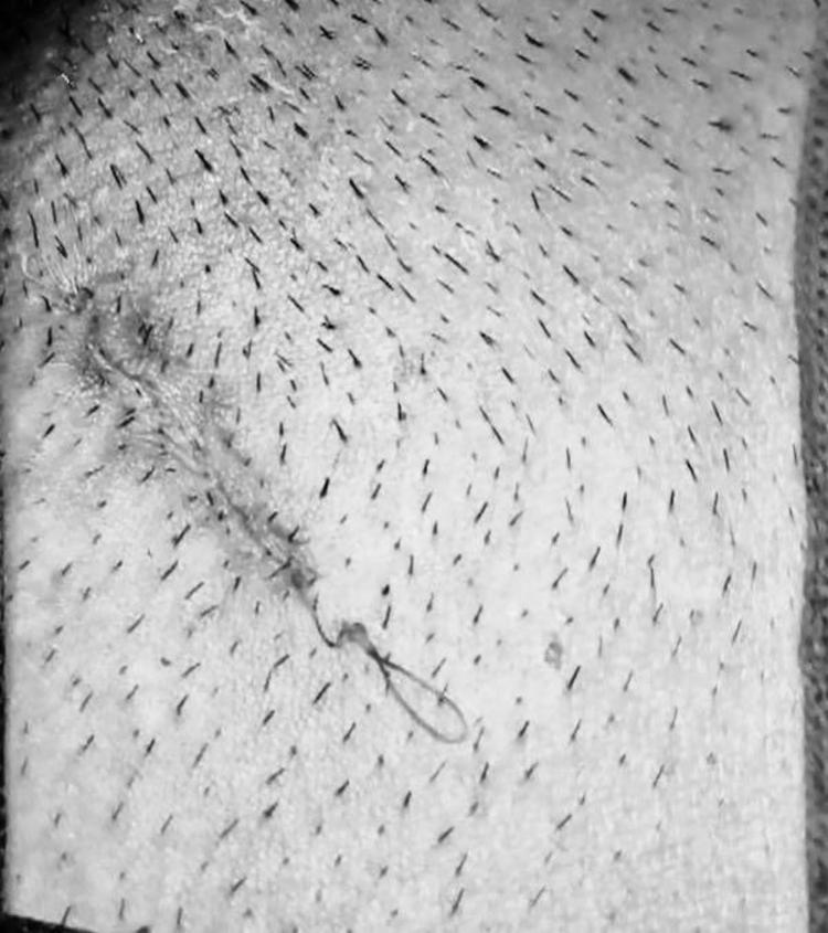 蛋蛋的忧伤-精索静脉曲张_刘铭医生文章_山东大学齐鲁医院(青岛)-微医