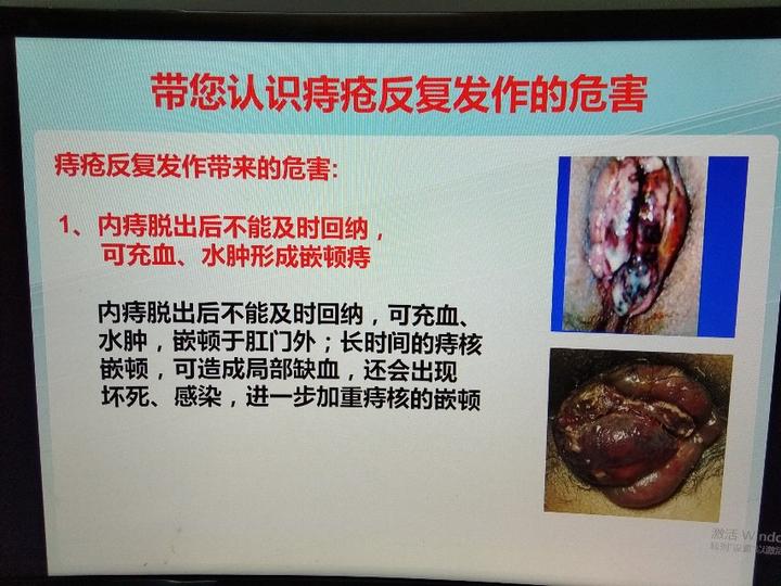 带你认识嵌顿痔的治疗原则