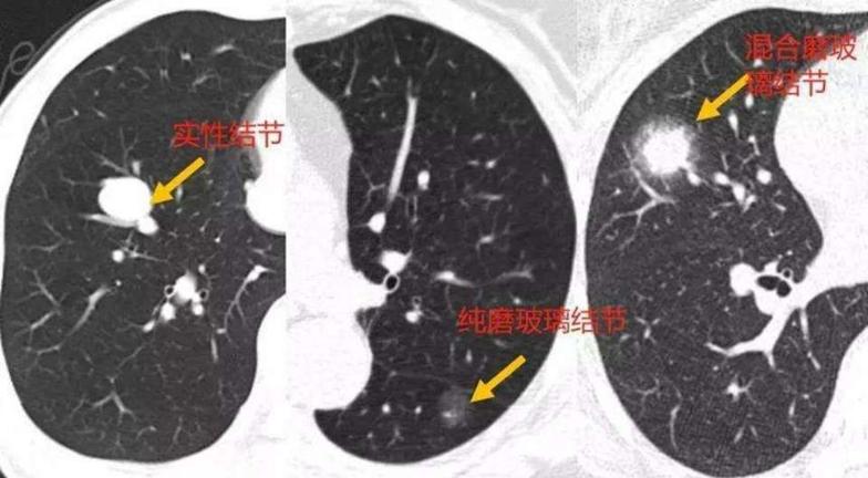 肺部结节诊治要点
