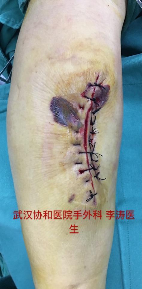 拔罐治疗不当烫伤皮肤引起伤口不愈合