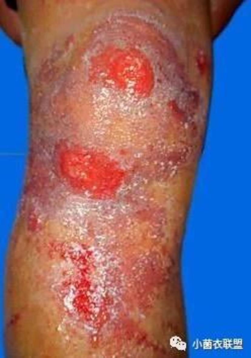 基底潮红,逐渐融合成片,搔抓后呈明显的点状渗出及小糜烂面,边缘不清