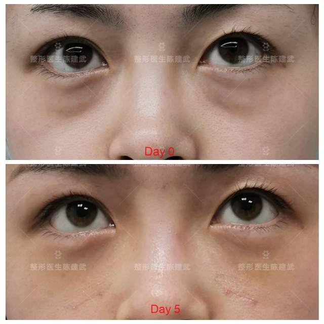 做完眼袋手术前后对比案例150