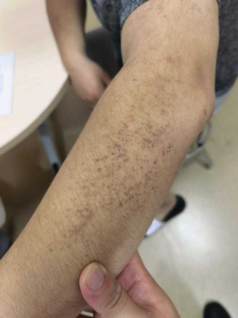 皮肤淀粉样变案例 - 微医(挂号网)