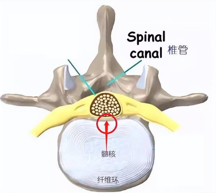 如果您突出间盘压迫的位置是靠近中央,压迫的主要是硬膜囊,对神经根