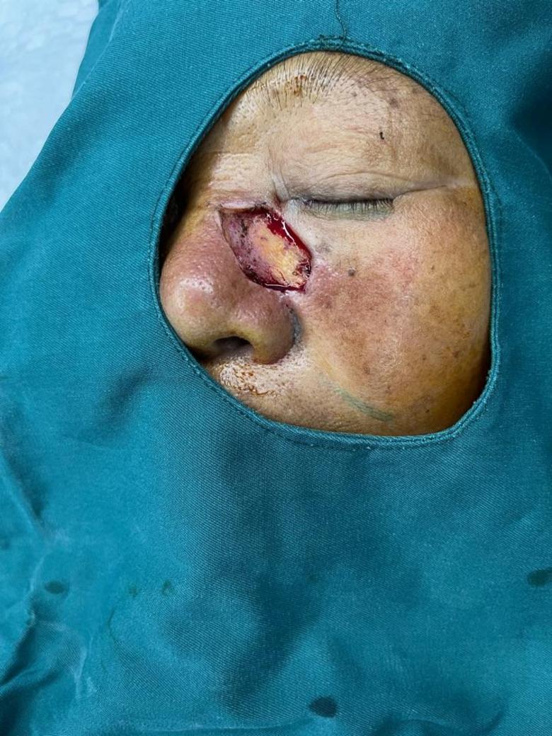 鼻背基底细胞癌扩切皮瓣修复