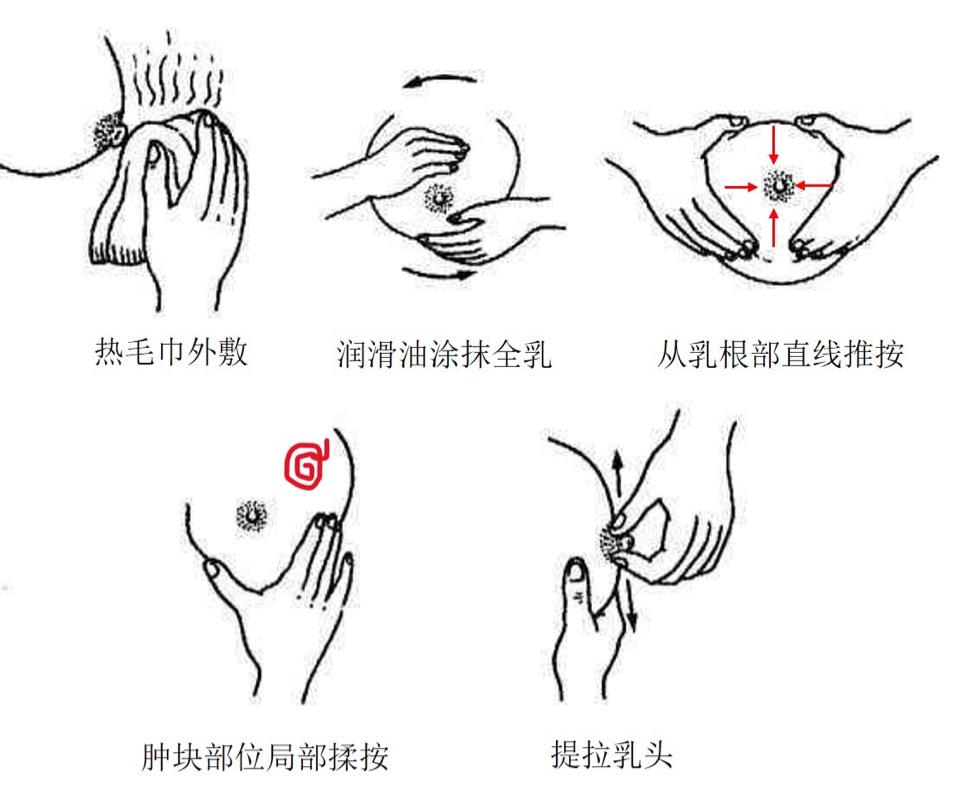 急性乳腺炎初期手法排乳步骤详解
