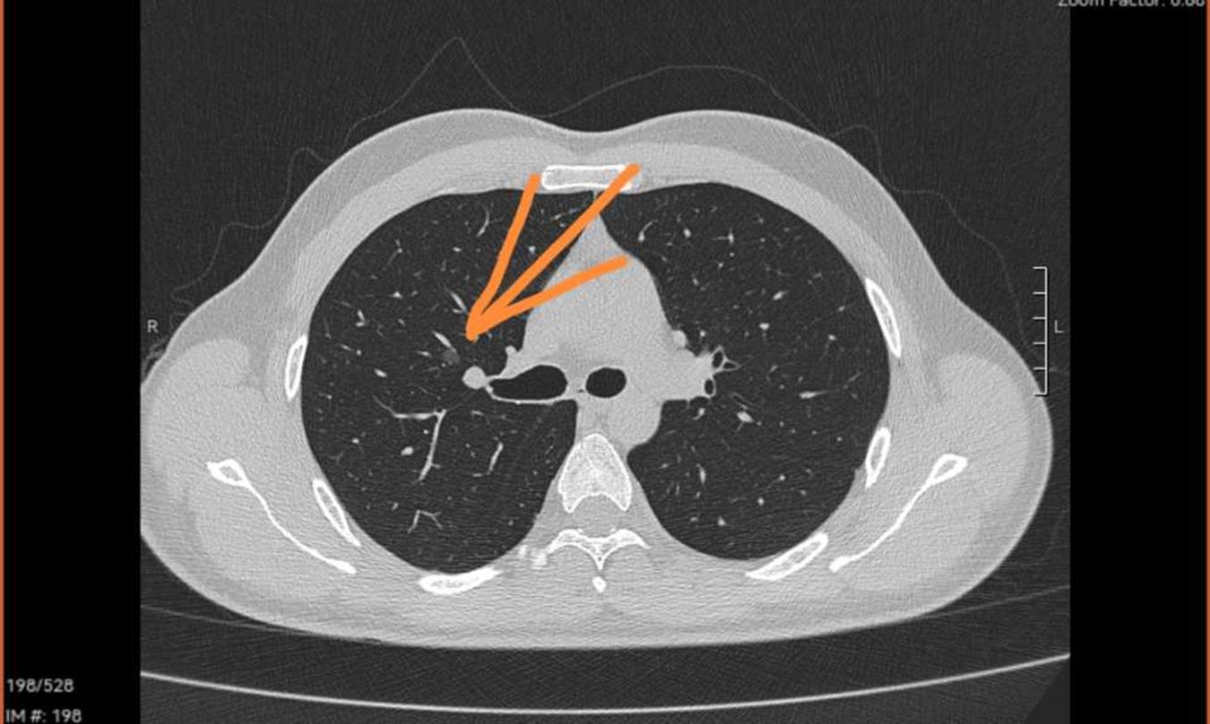 刘懿博士说肺癌(四〇一八)肺结节靠近肺门,会是中央型肺癌么?