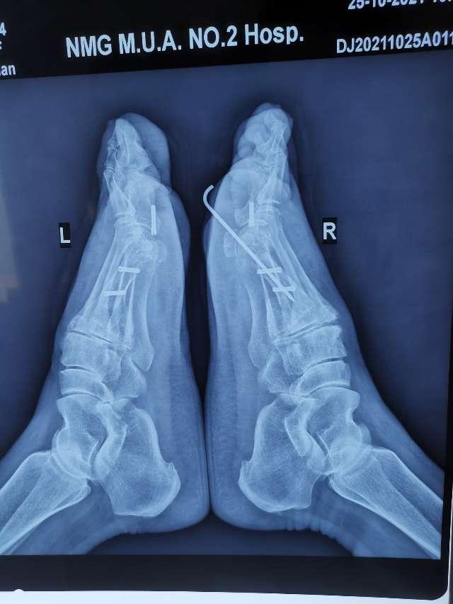 拇外翻大脚骨手术矫治术