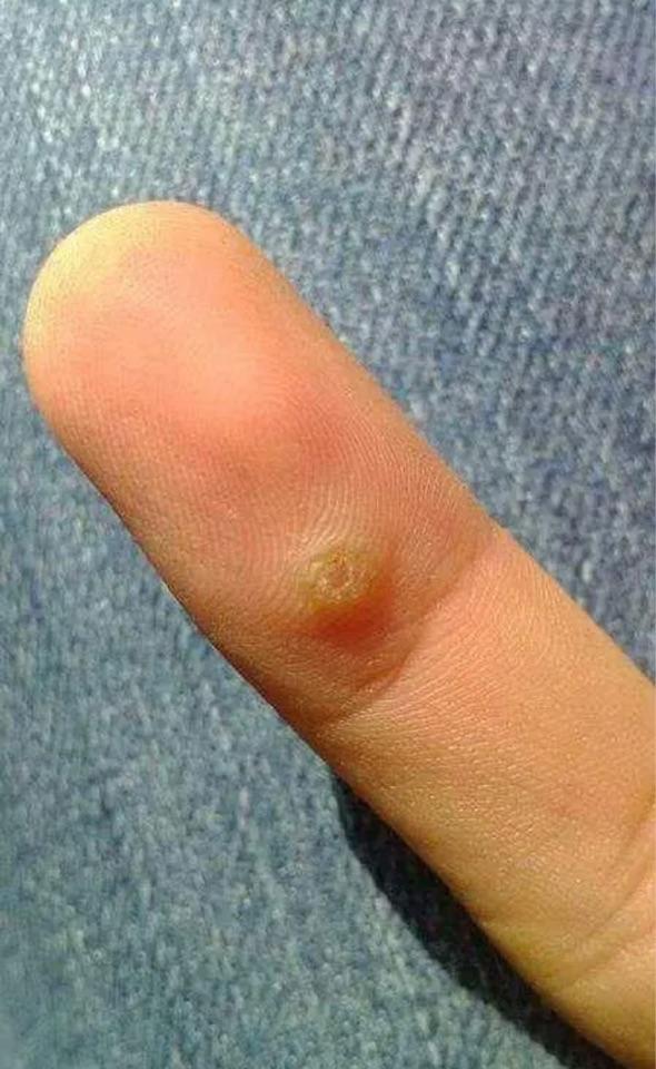 儿童常见疣有哪些?合适接种hpv疫苗吗? - 微医(挂号网)