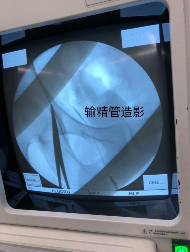 手术中同时做输精管造影检查,显示输精管道梗阻部位(2020.5.