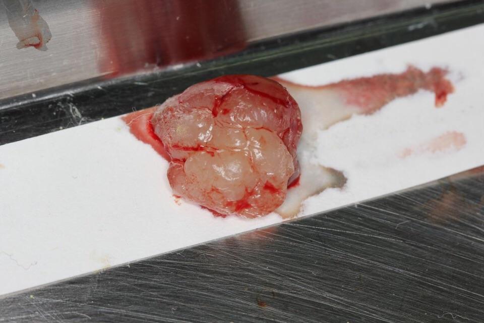 牙龈瘤,微创摘除3例! - 微医(挂号网)