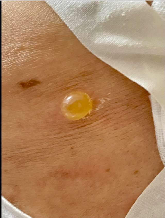 刘懿博士说肺癌六四五六肺结节术后贴胶带的皮肤上起水泡怎么办