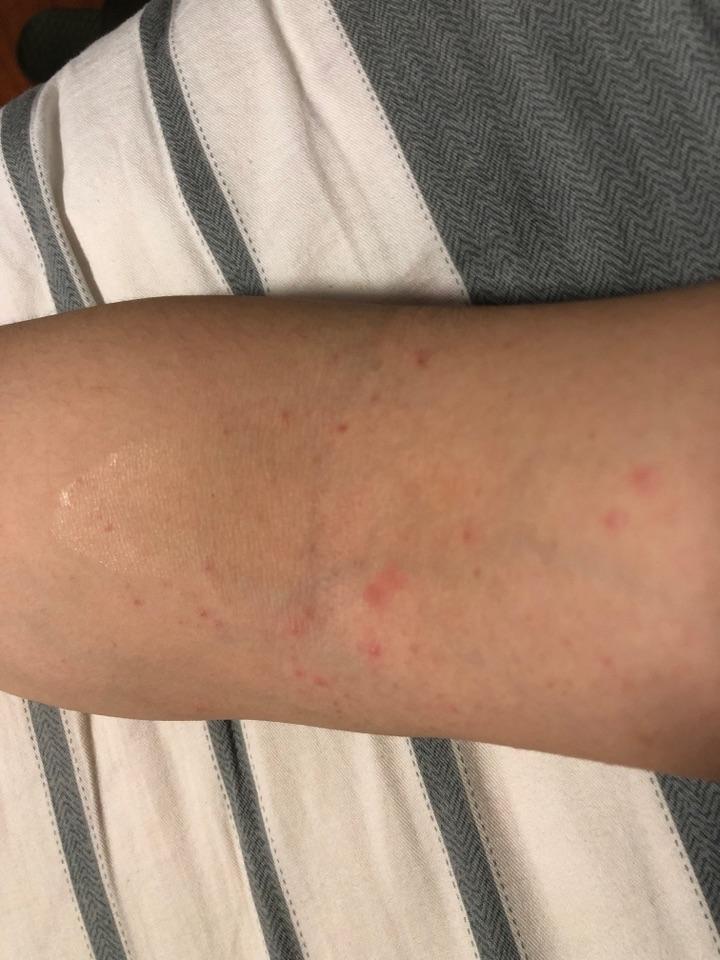 手肘内侧长了很多红点,也不痒,这个是什么呀?怎么治疗?