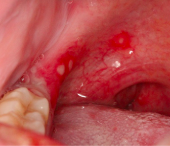 也就是说口腔疱疹是一个变化过程,早期是红点,然后发展为小水泡,最后