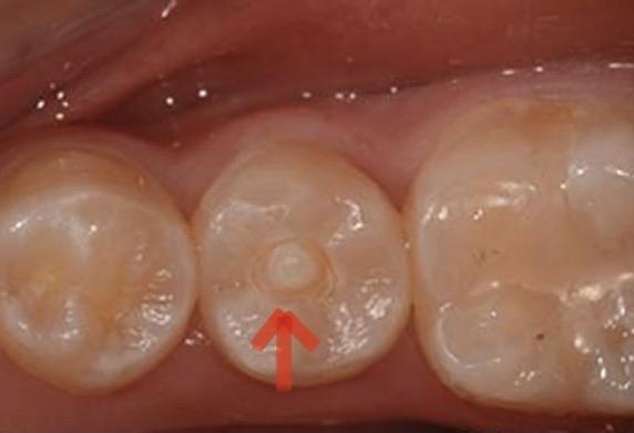 牙齿中央尖畸形图片