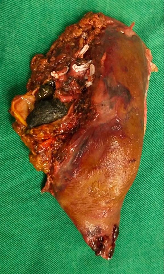 腹腔镜下精准手术治疗肝内胆管结石