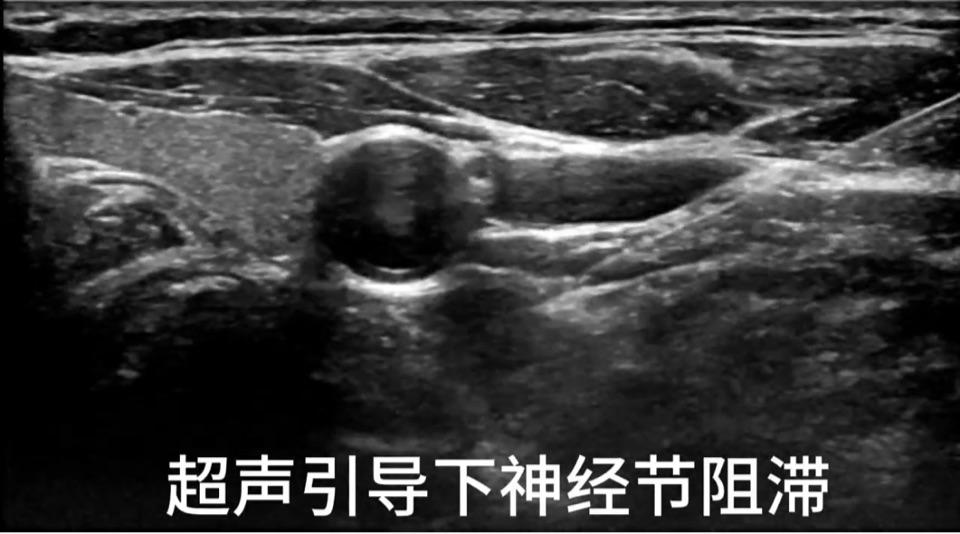 超声引导下对星状神经节阻滞对失眠偏头痛鼻炎有神奇效果