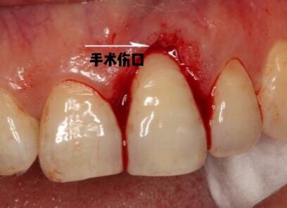 牙龈癌图片 手术图片
