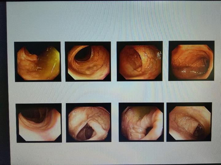 便血患者应重视肠镜检查尤其是既存在混合痔又存在直肠癌结肠癌时更应