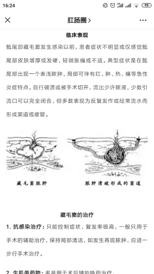 一根毛发引起的手术带你认识藏毛窦