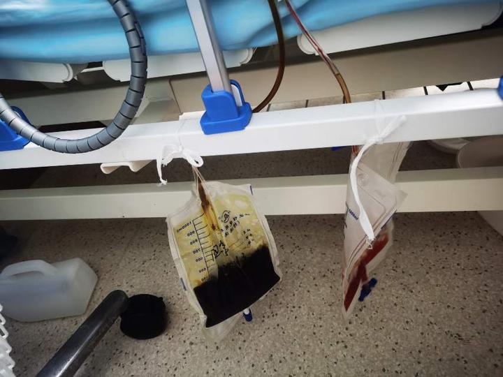 6,腹膜下盲襻埋置术5,经肠襻t管引流4,胆管空肠吻合3,肝门部胆管成形2